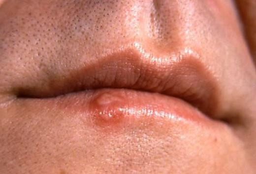 תסמינים של סרטן שפתיים